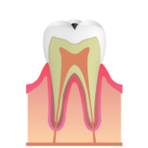 熊本市東区長嶺南のすけひろ歯科・kidsデンタルクリニック　C1 エナメル質が変色するむし歯
