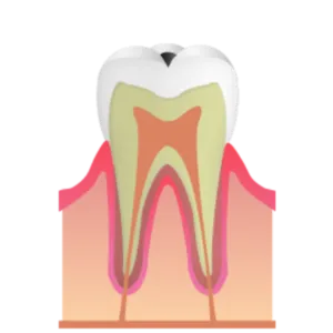 熊本市東区長嶺南のすけひろ歯科・kidsデンタルクリニック C1 エナメル質が変色するむし歯