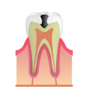 熊本市東区長嶺南のすけひろ歯科・kidsデンタルクリニック C2 象牙質が浸食されたむし歯