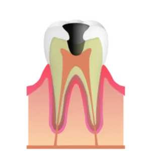 熊本市東区長嶺南のすけひろ歯科・kidsデンタルクリニック C3 神経に達したむし歯