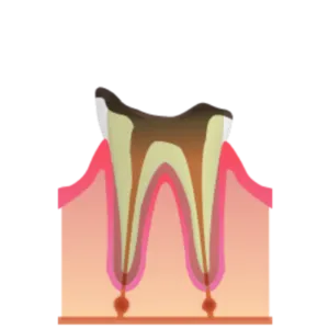 熊本市東区長嶺南のすけひろ歯科・kidsデンタルクリニック C4 歯根に達したむし歯