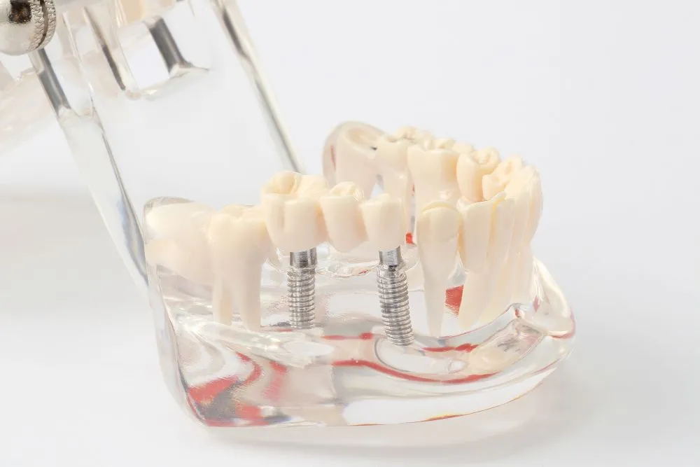 インプラント治療とは