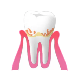 熊本市東区長嶺南のすけひろ歯科kidsデンタルクリニック 歯初期歯肉炎