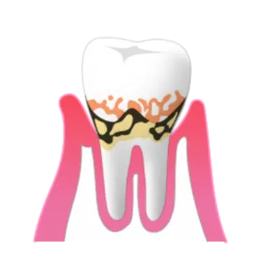 熊本市東区長嶺南のすけひろ歯科kidsデンタルクリニック 歯中度の歯肉炎