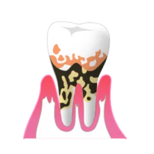 熊本市東区長嶺南のすけひろ歯科kidsデンタルクリニック 歯重度の歯肉炎